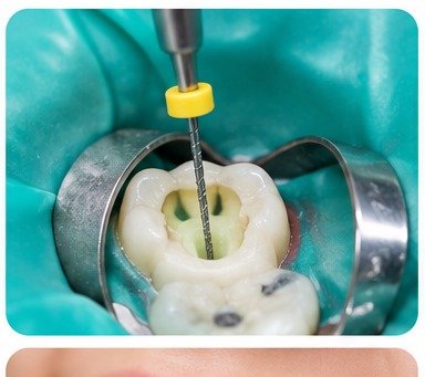 Root Canal Consultation in Lucknow